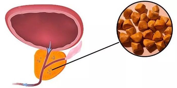 Kamenje prostate
