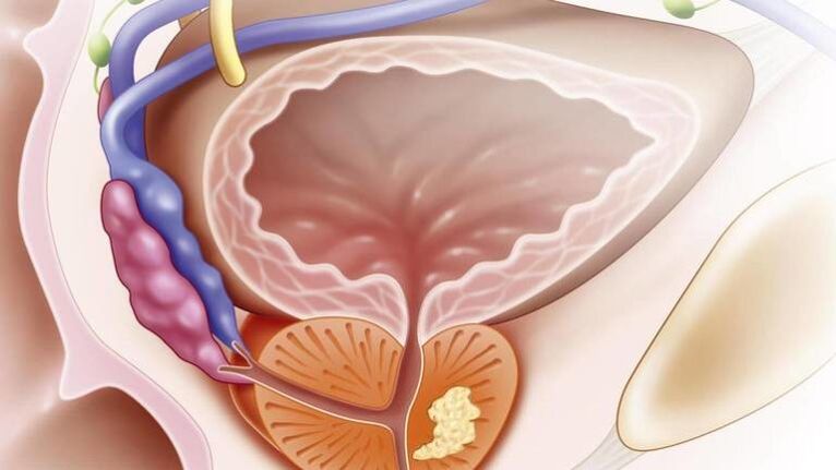 Kronični prostatitis